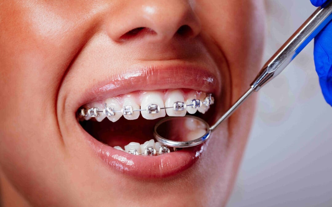 Tooth Extraction for Braces: Why It’s Necessary